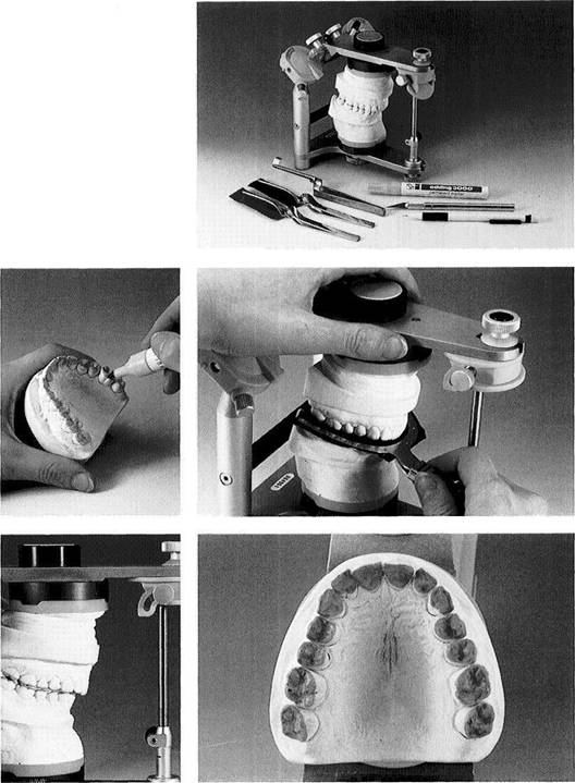 Mounting of Casts and Occlusal Analysis Dental