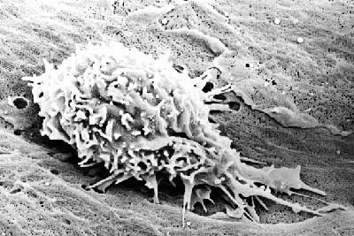 White blood cell adhering to the lining of the blood vessel from a model of human diabetes mellitus.jpg