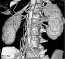 Abdominal aorta and arteries to the kidneys and intestines.