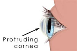 Keratoconus