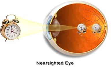 Myopia - Nearsightedness
