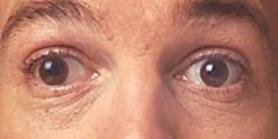 Strabismus - eye muscle imbalance