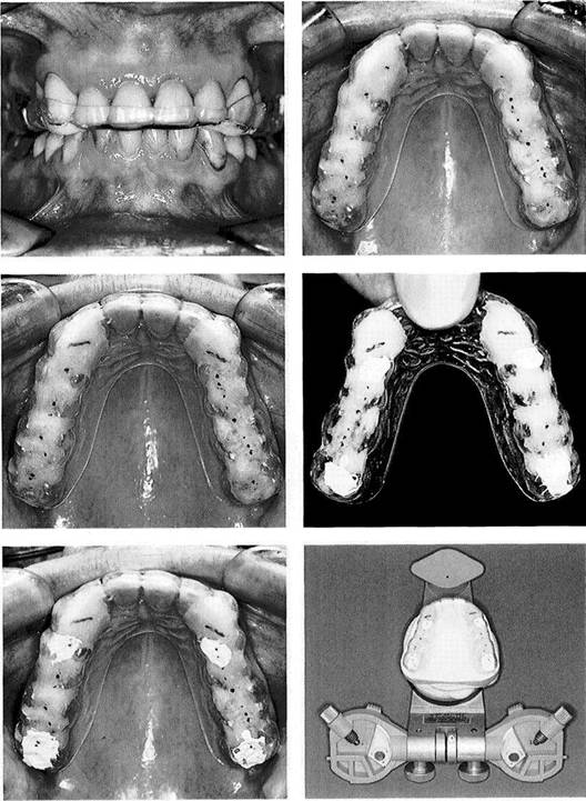 Mounting of Casts and Occlusal Analysis Dental