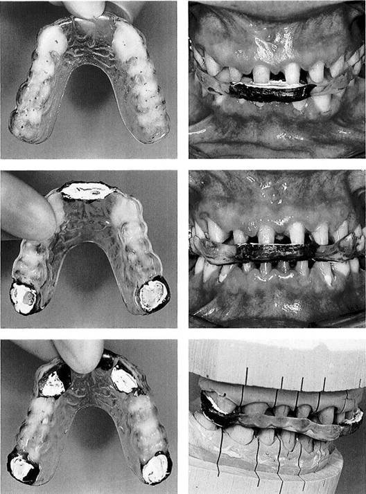 Mounting of Casts and Occlusal Analysis Dental