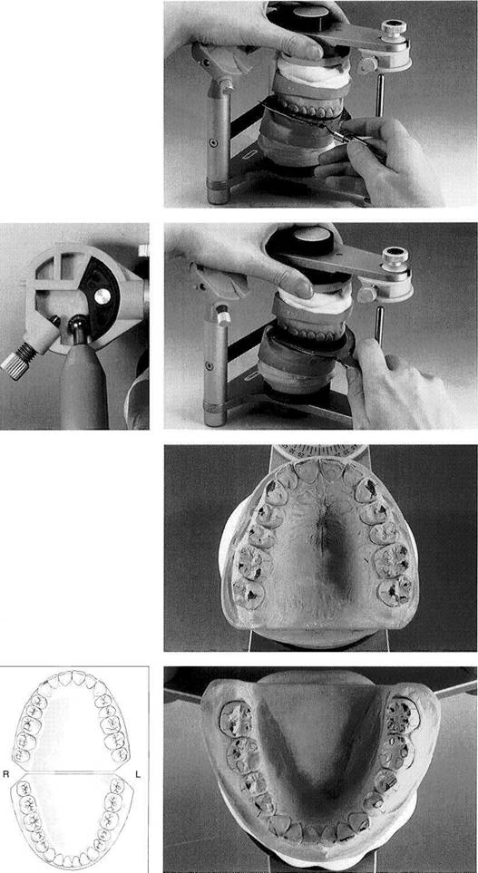 Mounting of Casts and Occlusal Analysis Dental