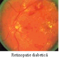 retinopatie diabetica.gif