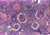 glomerulopatie diabetica.JPG