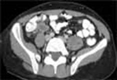 Appendicitis: The appendix is distended and inflamed. In this patient the appendix has not yet ruptured.
