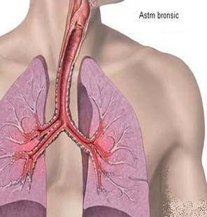Astm bronsic