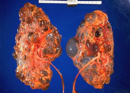 File:Polycystic kidneys, gross pathology 20G0027 lores.jpg