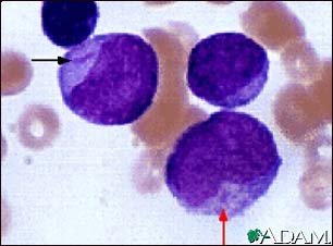 Acute Myelocytic Leukemia - Microscopic View
